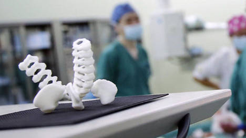 La prótesis 3D utilizada para separar a las siamesas