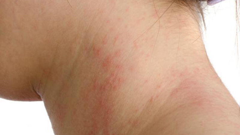 Cuáles son las alergias más frecuentes en verano? - Sociedad 