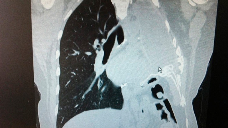 Tomografía computarizada que muestra la falta de un pulmón.