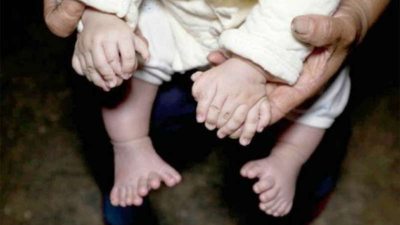 Las manos y los pies del beb&eacute; con 31 dedos.