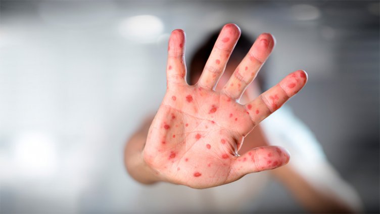 Alerta nacional por casos de sarampión: Reforzarán vacunación de niños