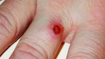 Alertan por cáncer de piel muy agresivo: La clave es el diagnóstico temprano