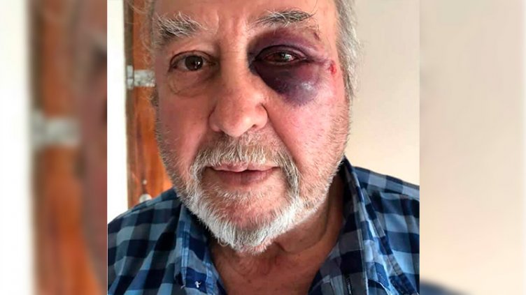 Asaltante golpeó en el rostro a hotelero tras robarle $20 que había en la caja