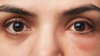 Revelan un nuevo síntoma de la variante Ómicron que se detecta en los ojos