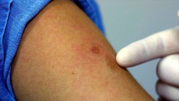 Viruela del mono: España comprará vacunas para controlar la enfermedad
