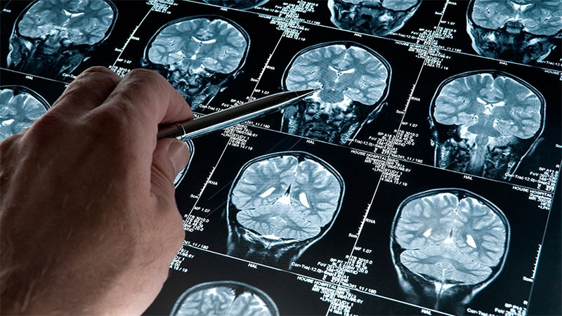 Descubren mecanismo para mejorar efecto de quimioterapia en tumores cerebrales - Sociedad - Elonce.com