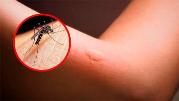 Dengue y encefalitis equina: cómo diferenciar las picaduras de los mosquitos