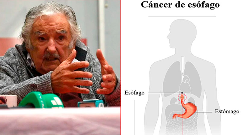 Cáncer de esófago: por qué aumentan los casos y quiénes tienen más riesgo