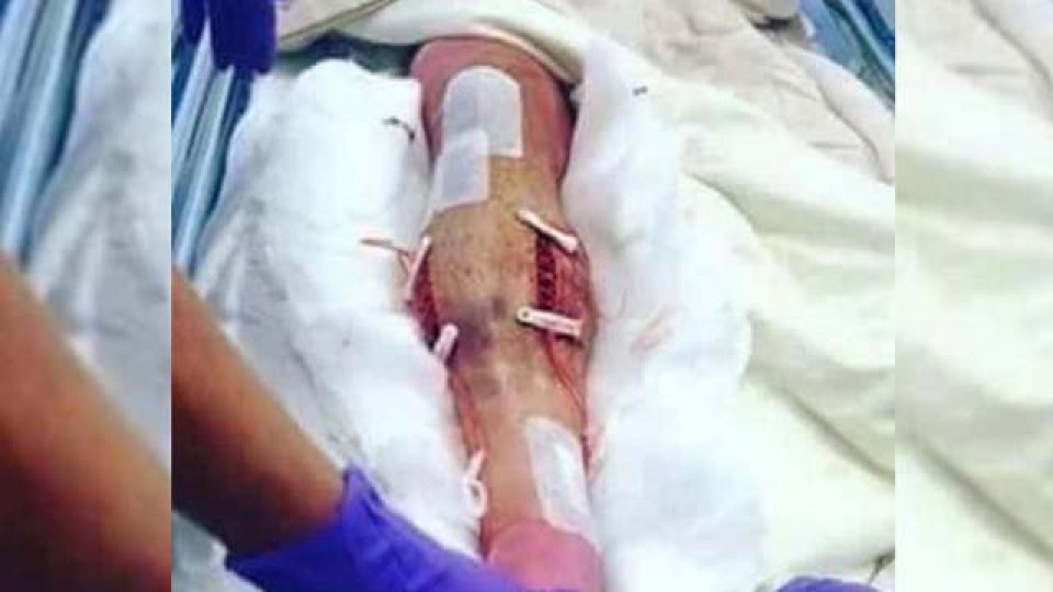 La pierna del lateral izquierdo del Manchester United luego de la operación.