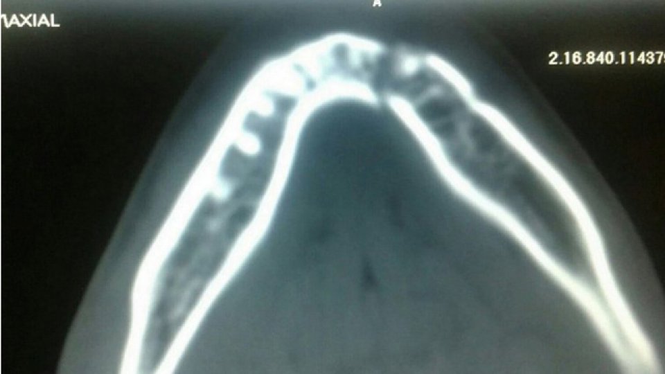 Imágenes de como quedó la mandíbula a Unsain por el golpe de Tevez.