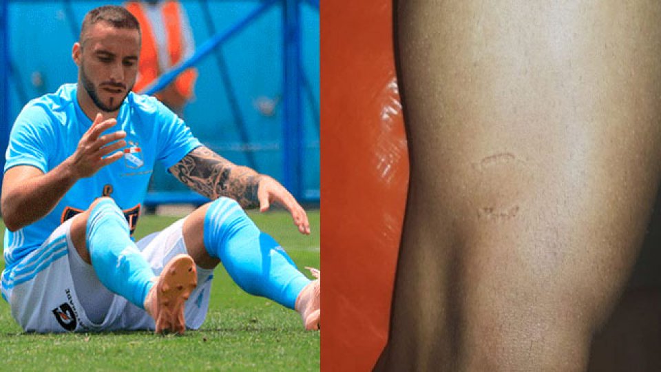 "El rival me mordió la pierna, el árbitro lo vio, lo sabía" aseguró Herrera.