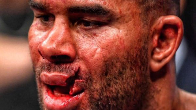 El rostro de Alistair Overeem, luego del certero golpe que le aplicó Jairzinho.