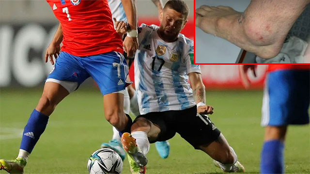 La impactante foto del tobillo del Papu Gómez tras el partido con Chile