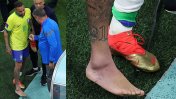Le lesión de Neymar: parte médico oficial y optimismo del futbolista