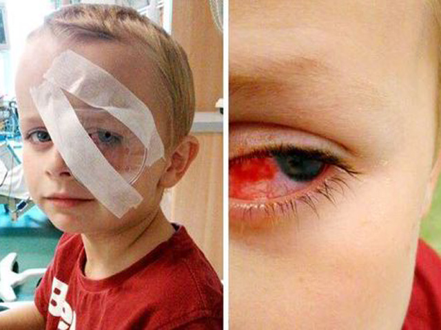 El niño herido en el ojo con las banditas de goma