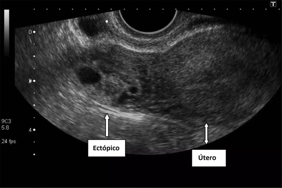 Ectopic pregnancy. Photo: Diplomadomedico.com