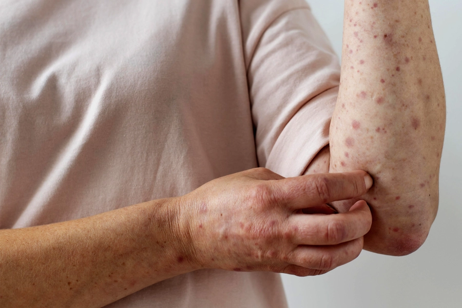 Alertan por sarampi&oacute;n tras viaje en colectivo: los s&iacute;ntomas a tener en cuenta