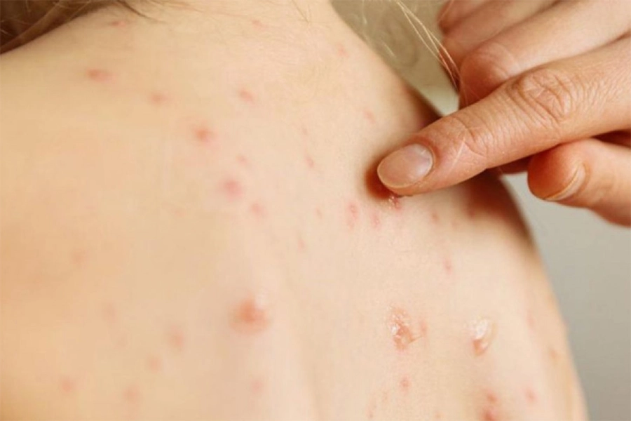 Refuerzan la prevenci&oacute;n del sarampi&oacute;n y recuerdan qu&eacute; s&iacute;ntomas deben motivar consulta