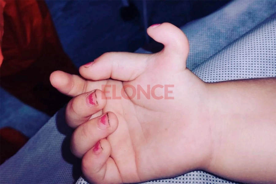 Así era la manito de la nena entrerriana que fue operada por polidactilia en el San Roque