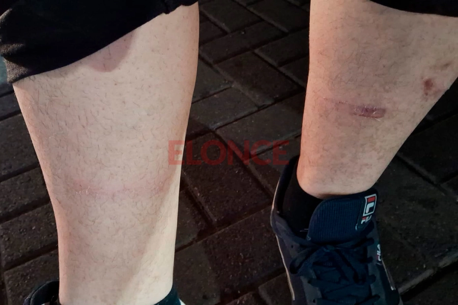 Las heridas que sufri&oacute; el inspector atropellado (foto Elonce)