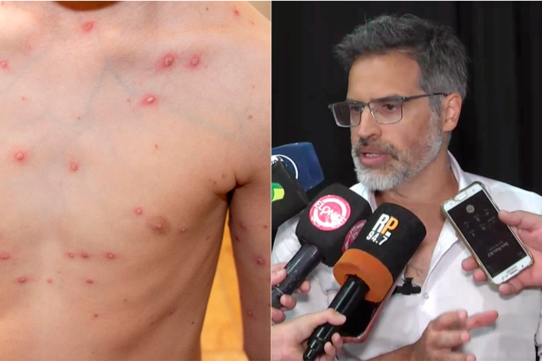 Brote de varicela en Entre Ríos: confirmaron 700 casos y la mayoría son adolescentes