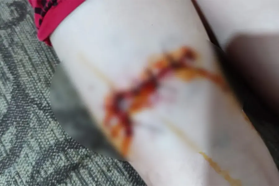 El nene sufri&oacute; una importante herida en la pierna