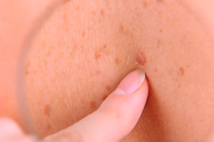 C&aacute;ncer de piel