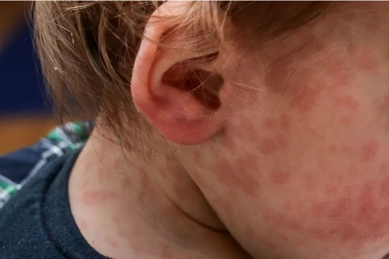 Se confirmó un caso de sarampión en Entre Ríos y se convocó una comisión de vigilancia