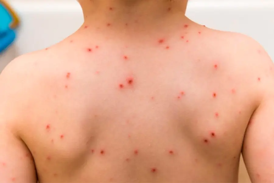 Colonia religiosa anti vacunas concentra mayor&iacute;a de casos de sarampi&oacute;n en Uruguay