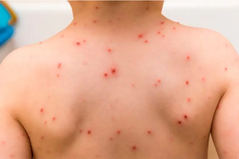 Se activó un protocolo sanitario por otro posible caso de sarampión en Entre Ríos