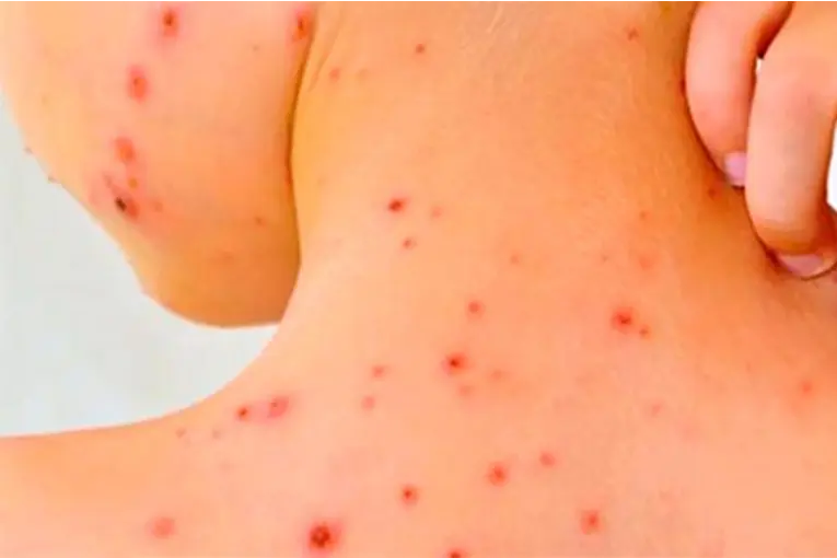 Detectaron un posible caso de sarampión en otra localidad entrerriana