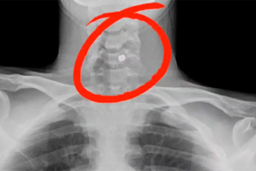 La bala alojada en el cuerpo del joven.