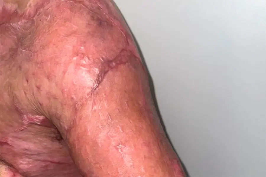 La recuperaci&oacute;n del brazo del paciente quemado en una explosi&oacute;n