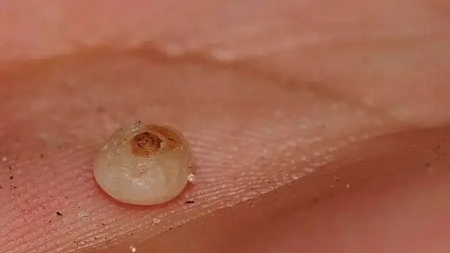 Infecci&oacute;n del "bicho de p&eacute;"