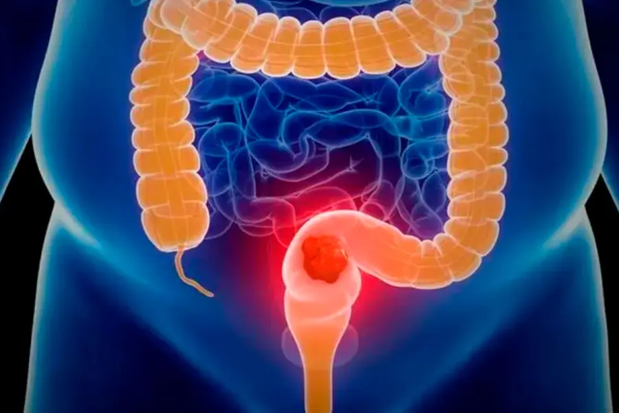 M&aacute;s de la mitad de los casos podr&iacute;an prevenirse con h&aacute;bitos saludables. Foto: BBC.