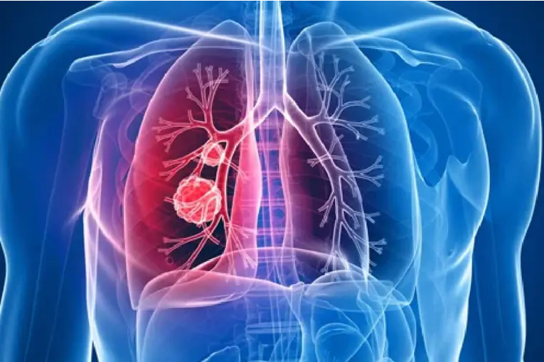 El tabaquismo y el alcohol, principales causas de cáncer prevenible, alertó la OMS