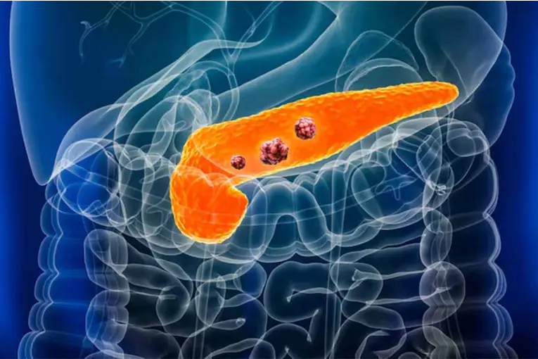 Un fármaco experimental mostró resultados históricos contra cáncer de páncreas