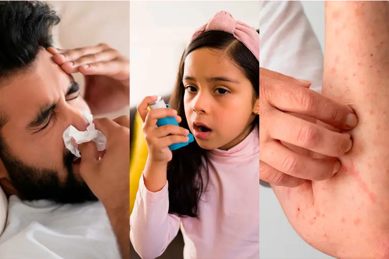 Día Mundial de la Alergia: especialista explicó cuándo consultar y cómo mejorar los síntomas